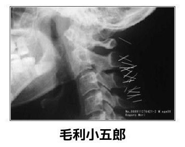 突然有一天，毛利小五郎觉得脖子很不舒服……[吃惊]